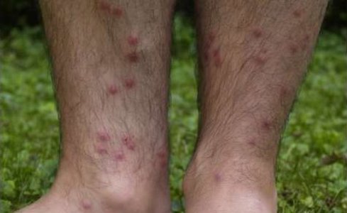Zwemmersjeuk (Cercerial dermatitis) op onderbenen - Foto: Cornellier / CC BY-SA 3.0
